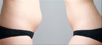 Still Have a Postpartum Belly? It May Be Diastasis Recti, Not Fat